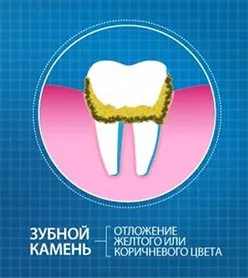 зубной-камень.jpg